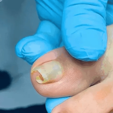 FungiClear™ – Suero Reparador para Uñas - Meriva 🇲🇽