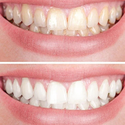 Smiley | Blanqueador Dental