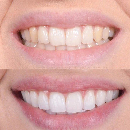 Smiley | Blanqueador Dental