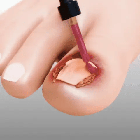 FungiClear™ – Suero Reparador para Uñas
