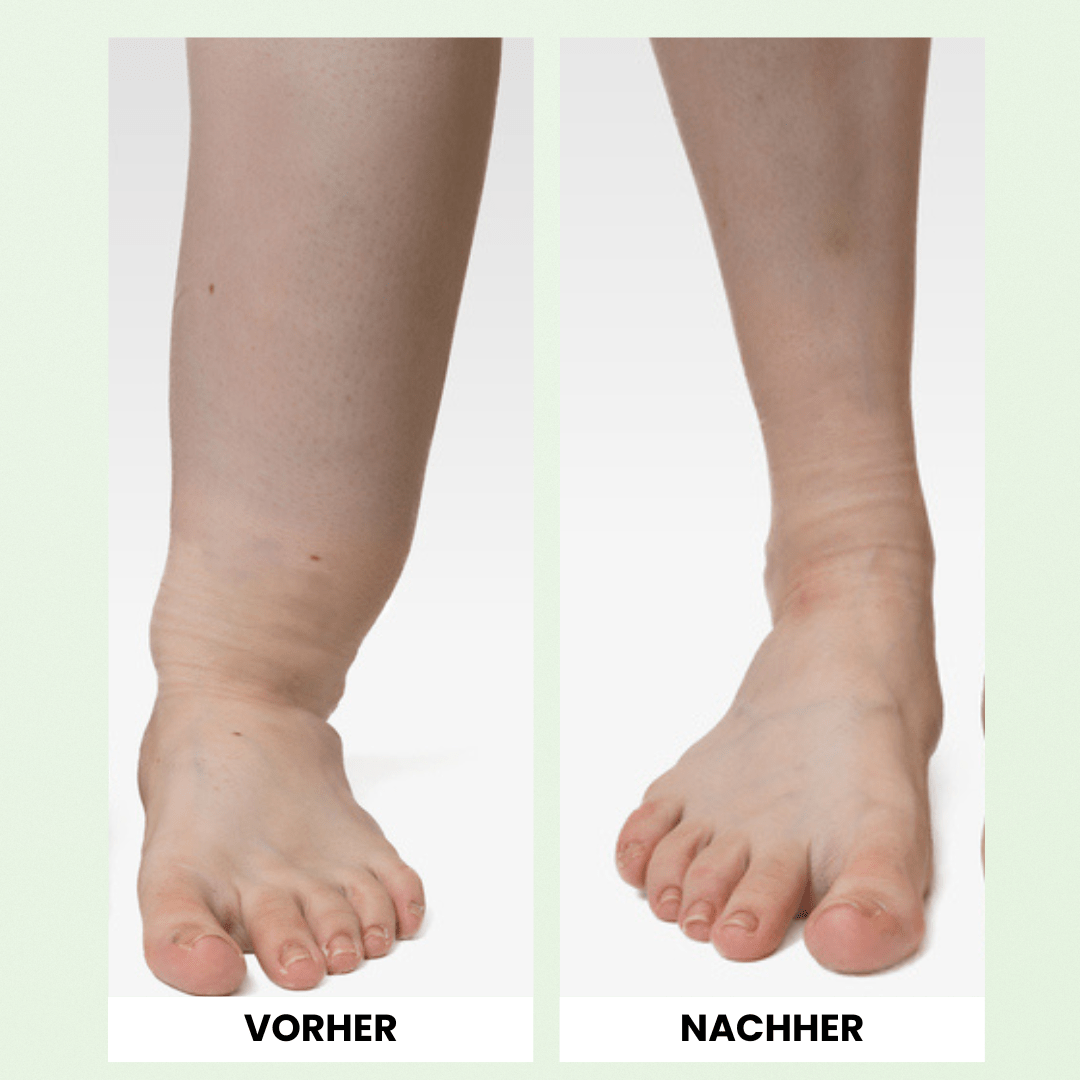 OrthoMax® Linfático - Dispositivo Terapéutico contra Linfedemas y Retenciones de Agua - Meriva 🇲🇽