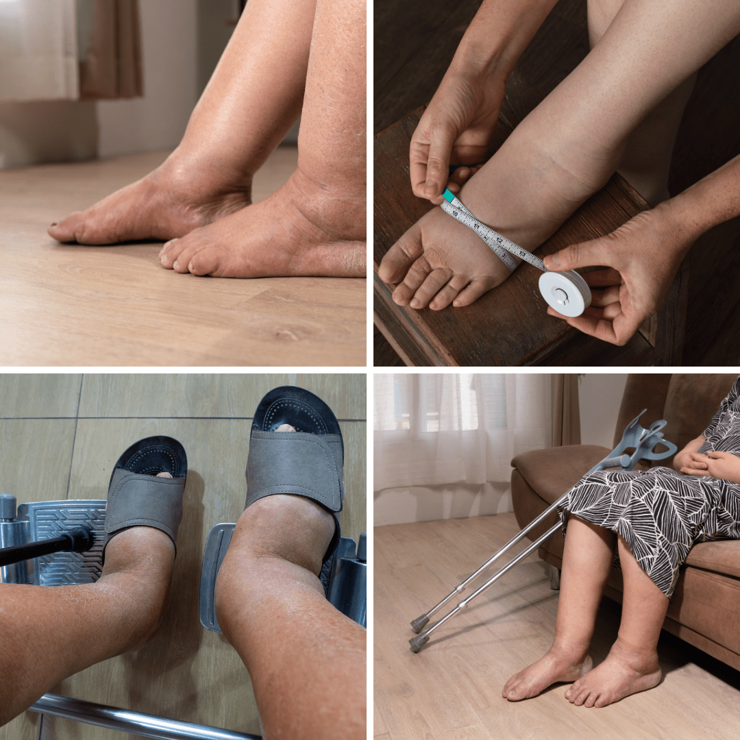 OrthoMax® Linfático - Dispositivo Terapéutico contra Linfedemas y Retenciones de Agua - Meriva 🇲🇽