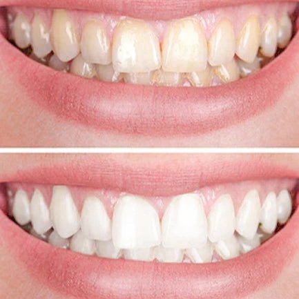 Smiley | Blanqueador Dental - Meriva 🇲🇽